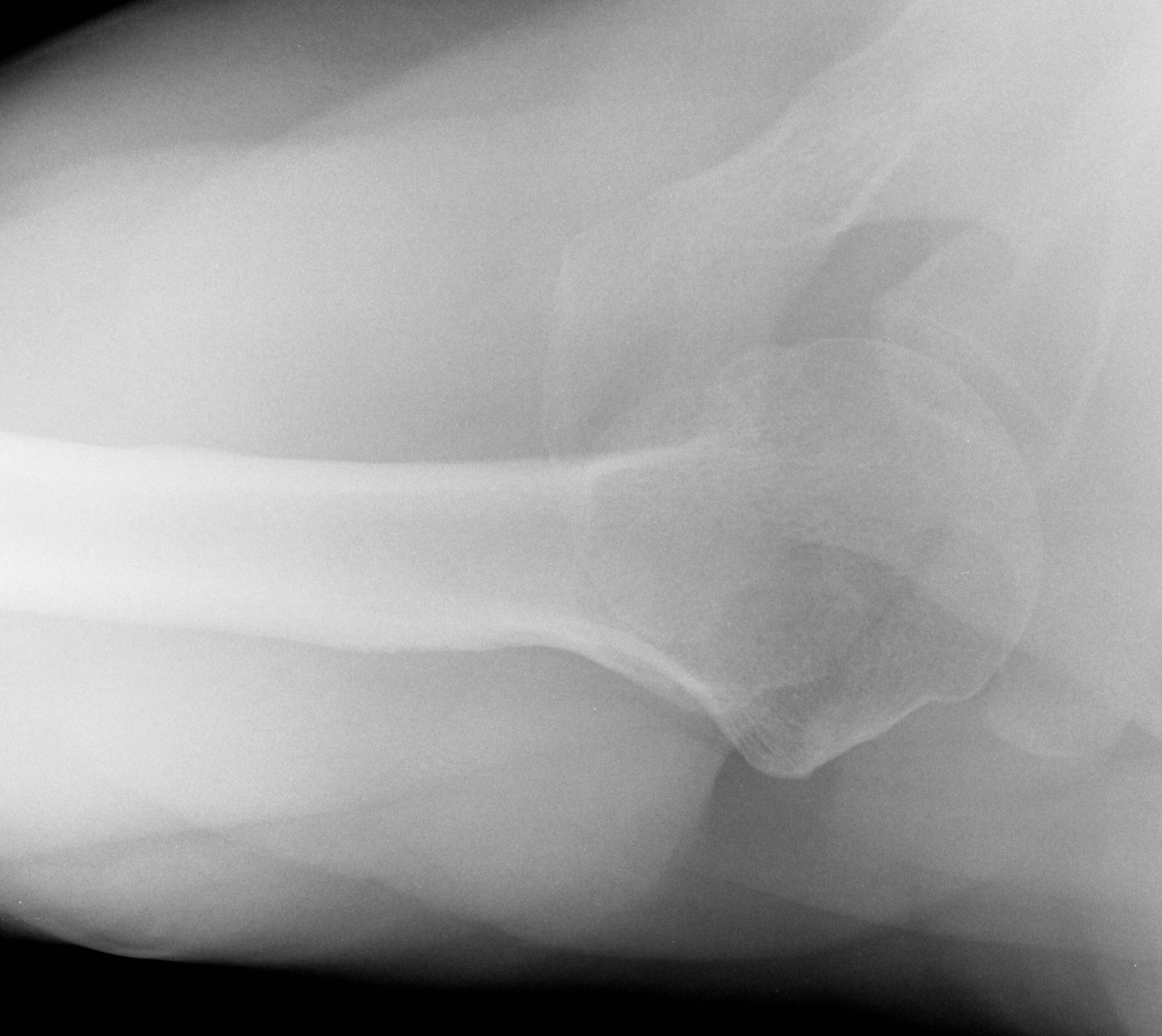 Axillary Lateral Xray